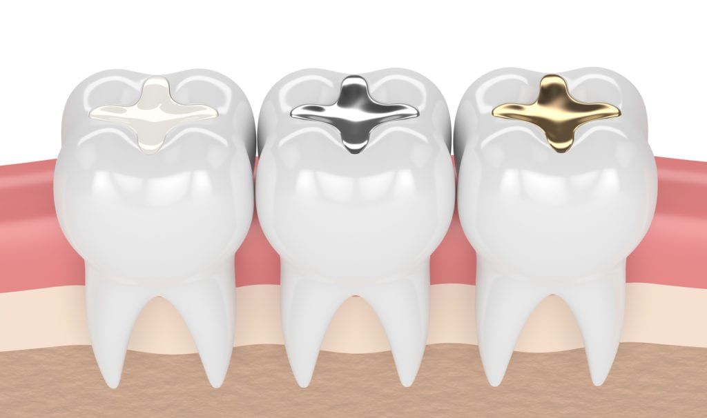 teeth with gold, amalgam and composite inlay dental filling in gums
