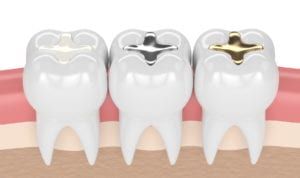 teeth with gold, amalgam and composite inlay dental filling in gums