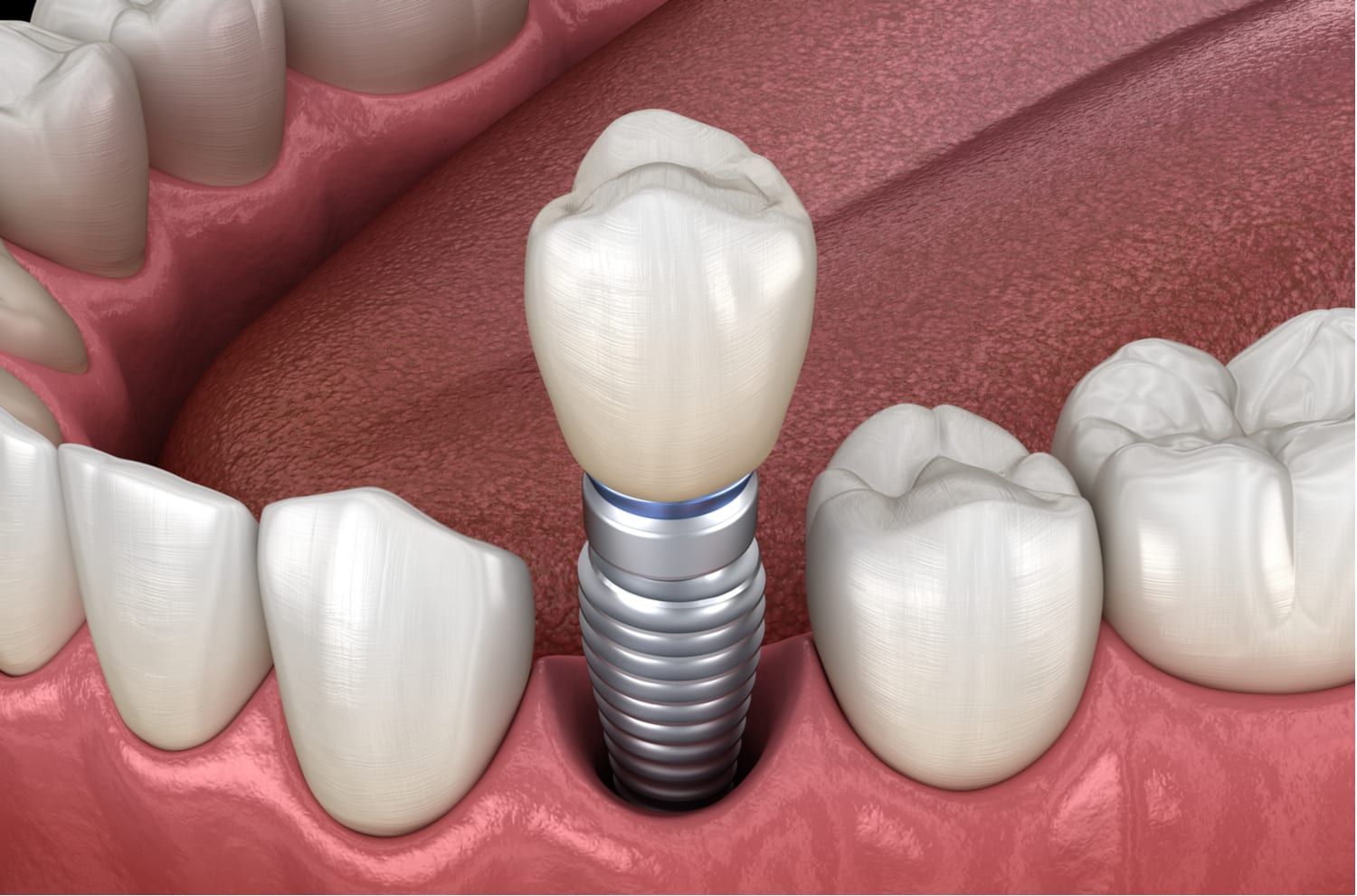 Титановые импланты для зубов