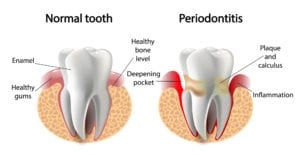 difference b/w normal tooth and periodontitis
