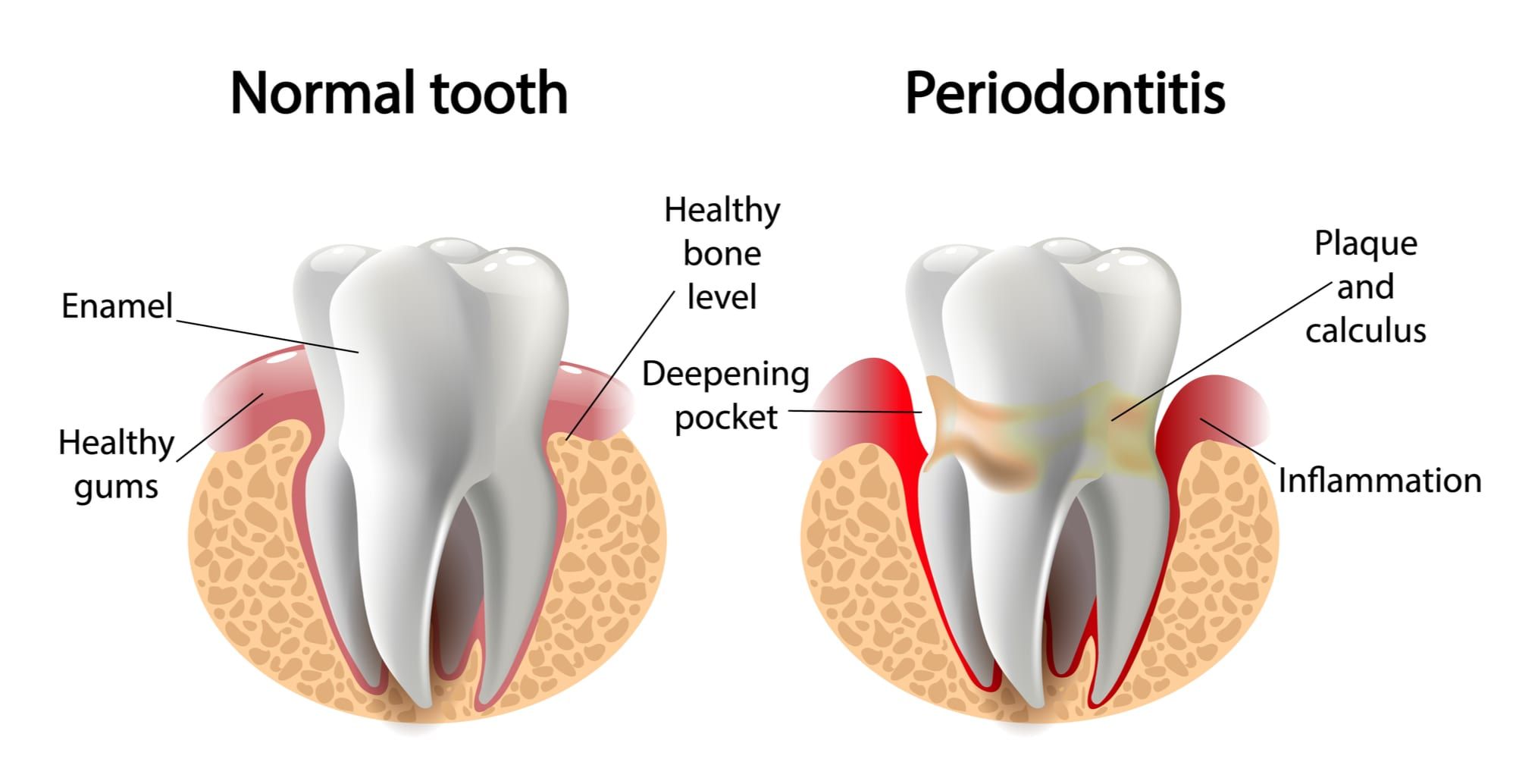 Dental Plaque, Causes, Prevention, Treatment & Removal of Plaque