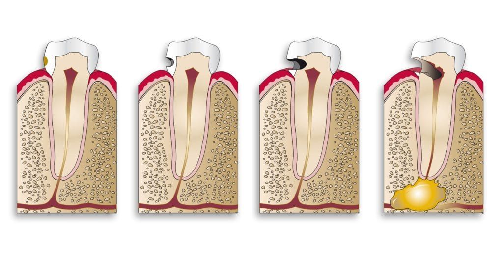 Diagram showing the progression of a cavity