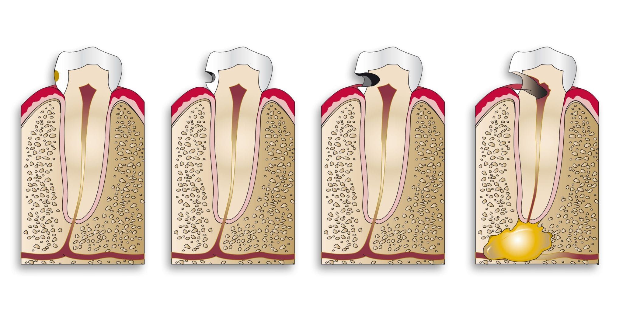 Кариес зубов деминерализация. Пришеечный кариес, кариес корня зуба.