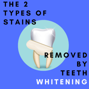 The 2 Types of Stains Removed by Teeth Whitening
