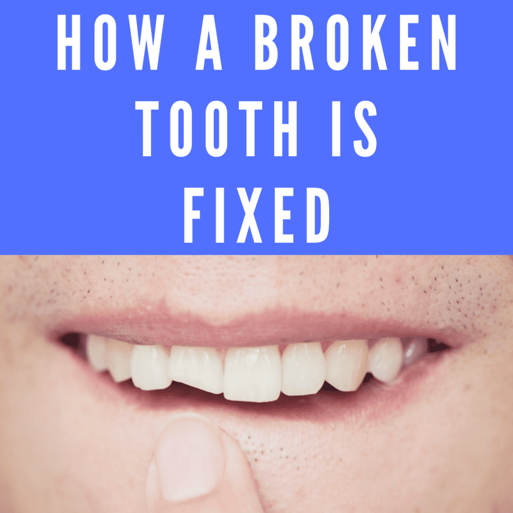 How a Broken Tooth is Fixed