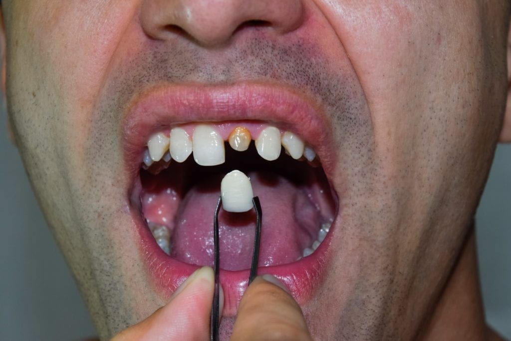 Dental crown being used to restore a severely damaged tooth
