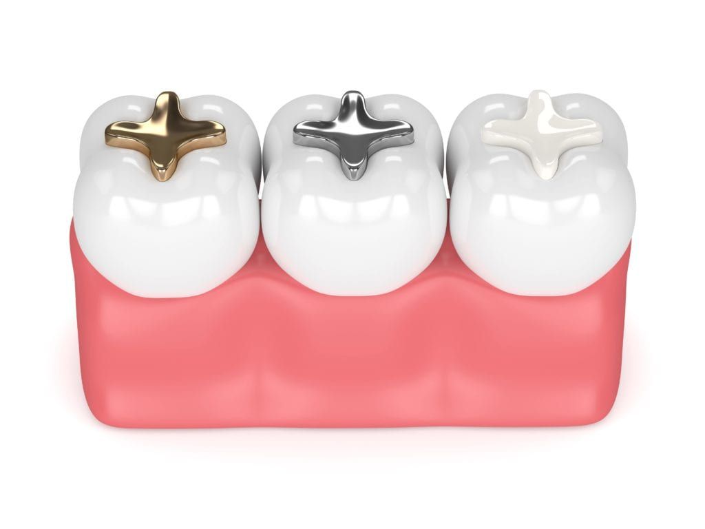 Dental fillings made from gold, amalgam, and composite