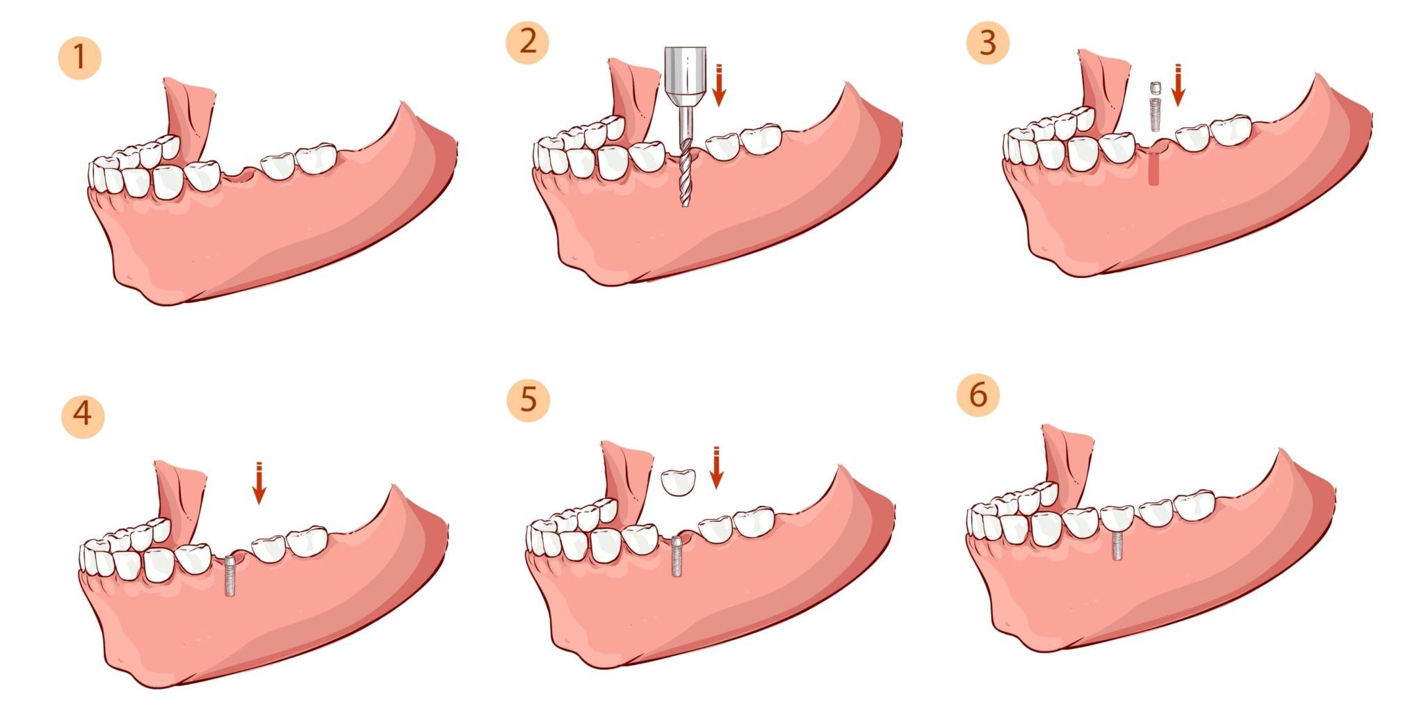 Зубы импланты поэтапно. Этапы имплантации зубов. Поэтапное имплантирование зубов. Двухэтапная методика имплантации зубов.
