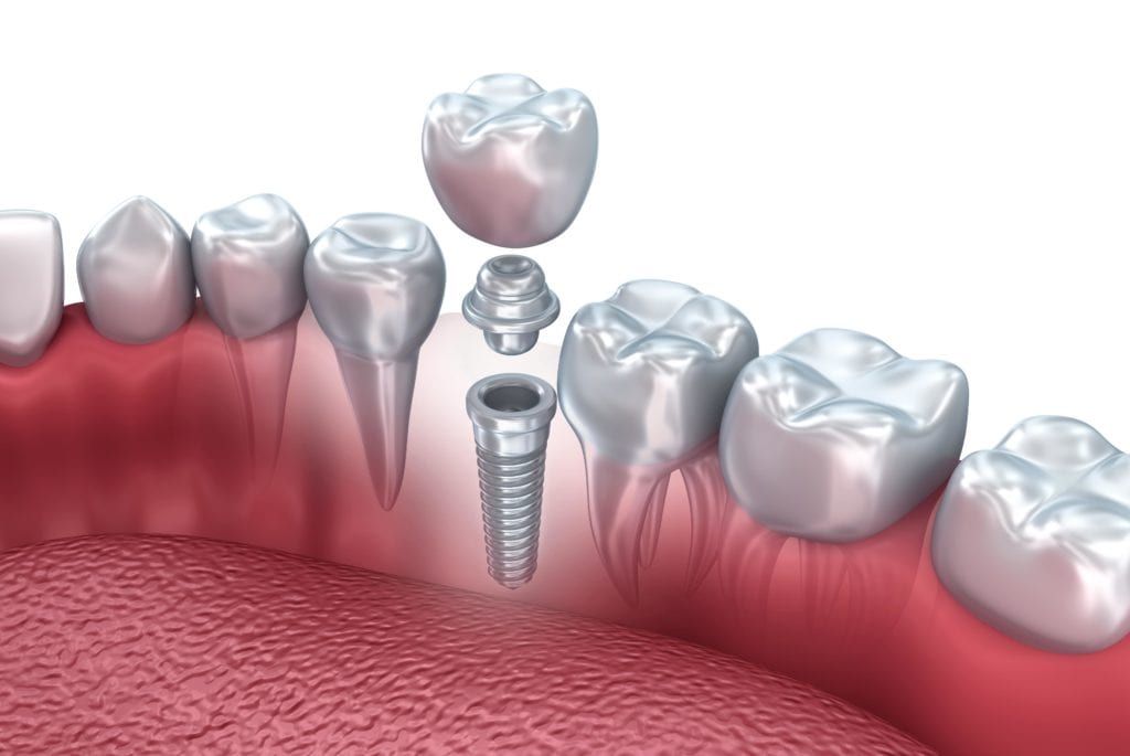 dental implant surrounded by natural teeth